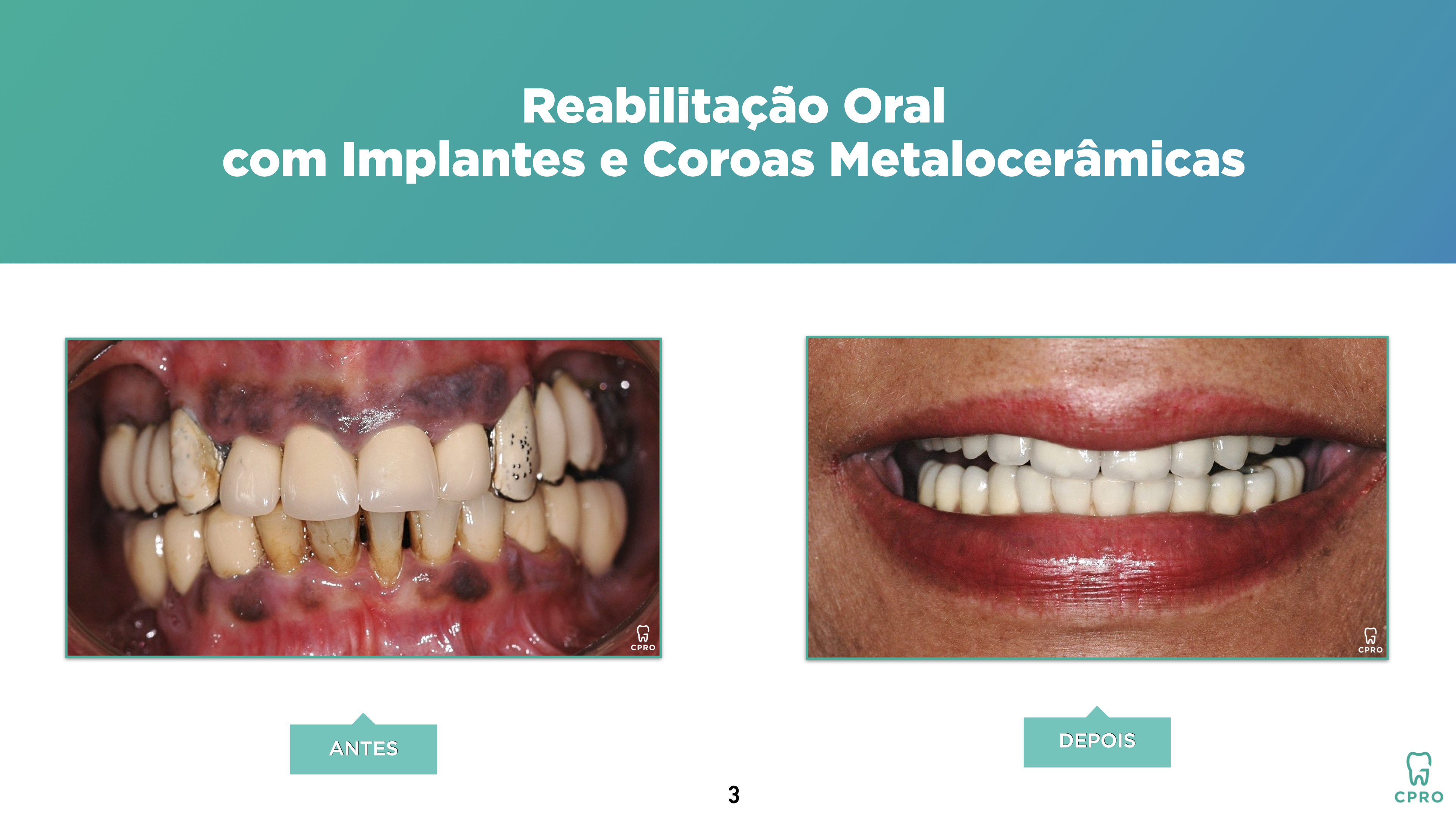 Estética | Implantes | Prótese Fixa
