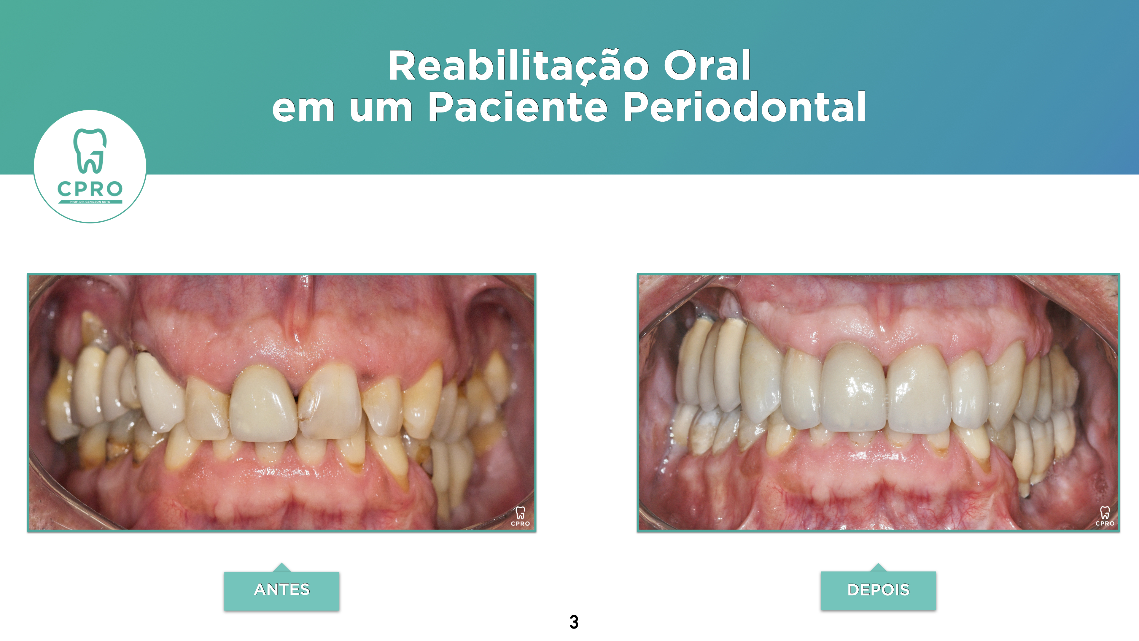 Periodontia | Prótese Fixa