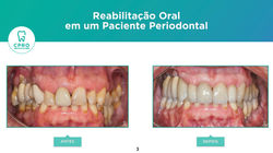 Periodontia | Prótese Fixa