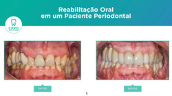 Periodontia | Prótese Fixa