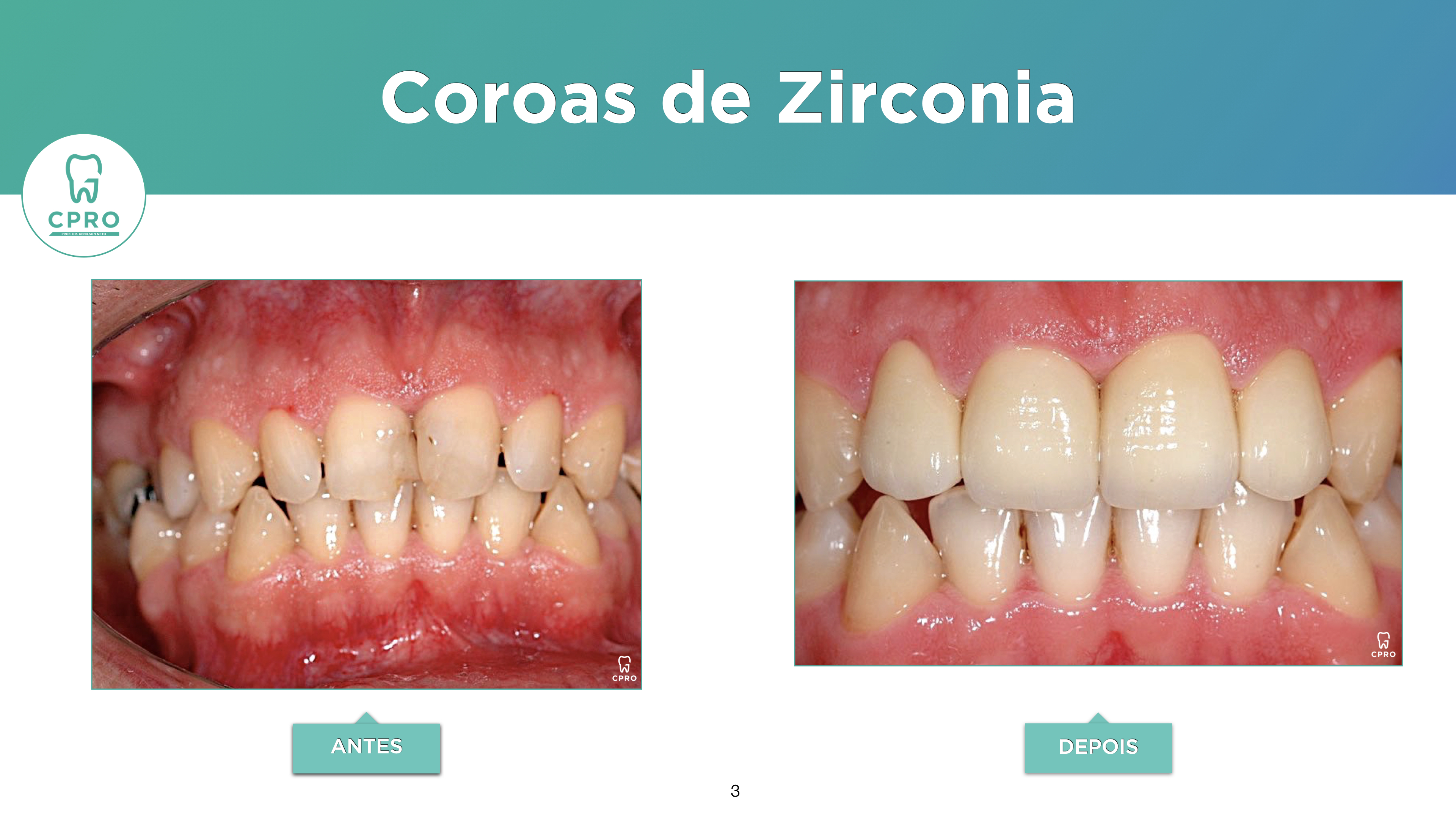 Prótese Dentária