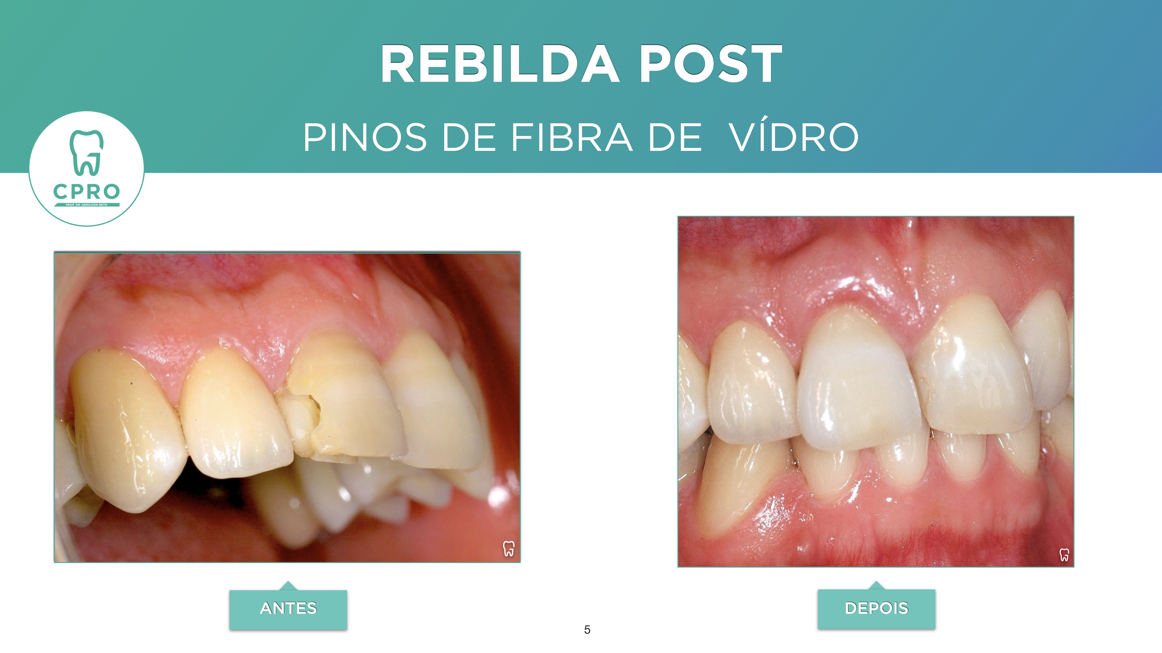 Prótese Dentária