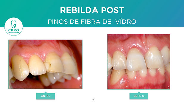 Reconstrução de Dente Anterior.jpeg