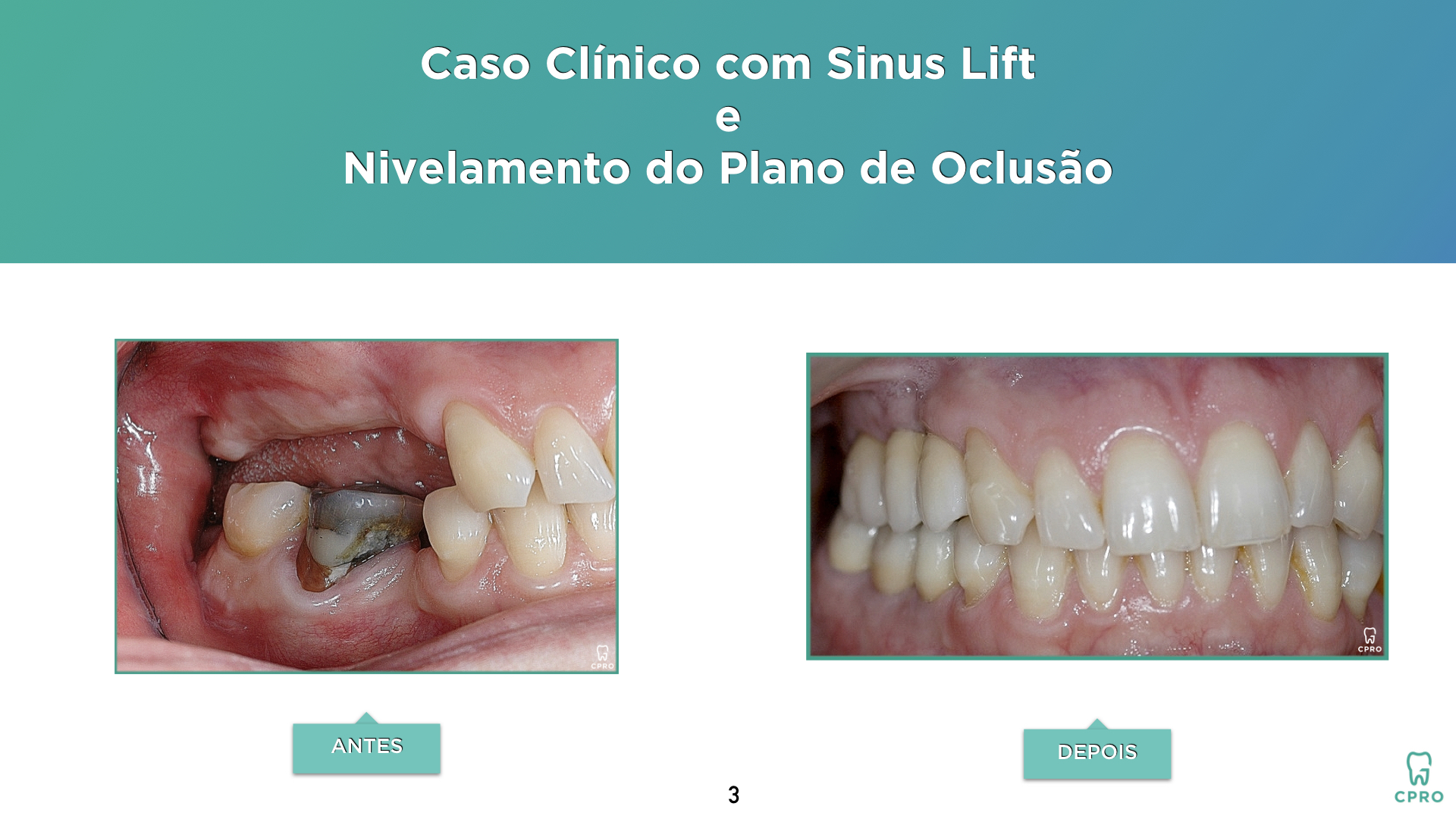 Oclusão | Implantes | Prótese Fixa