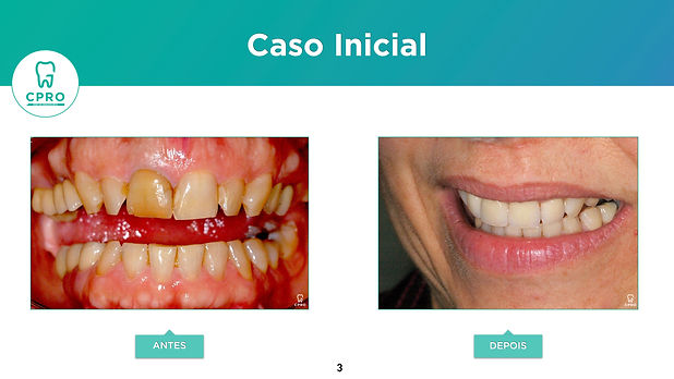 Coroas Metal-Free (Alumina) (Caso Isabel