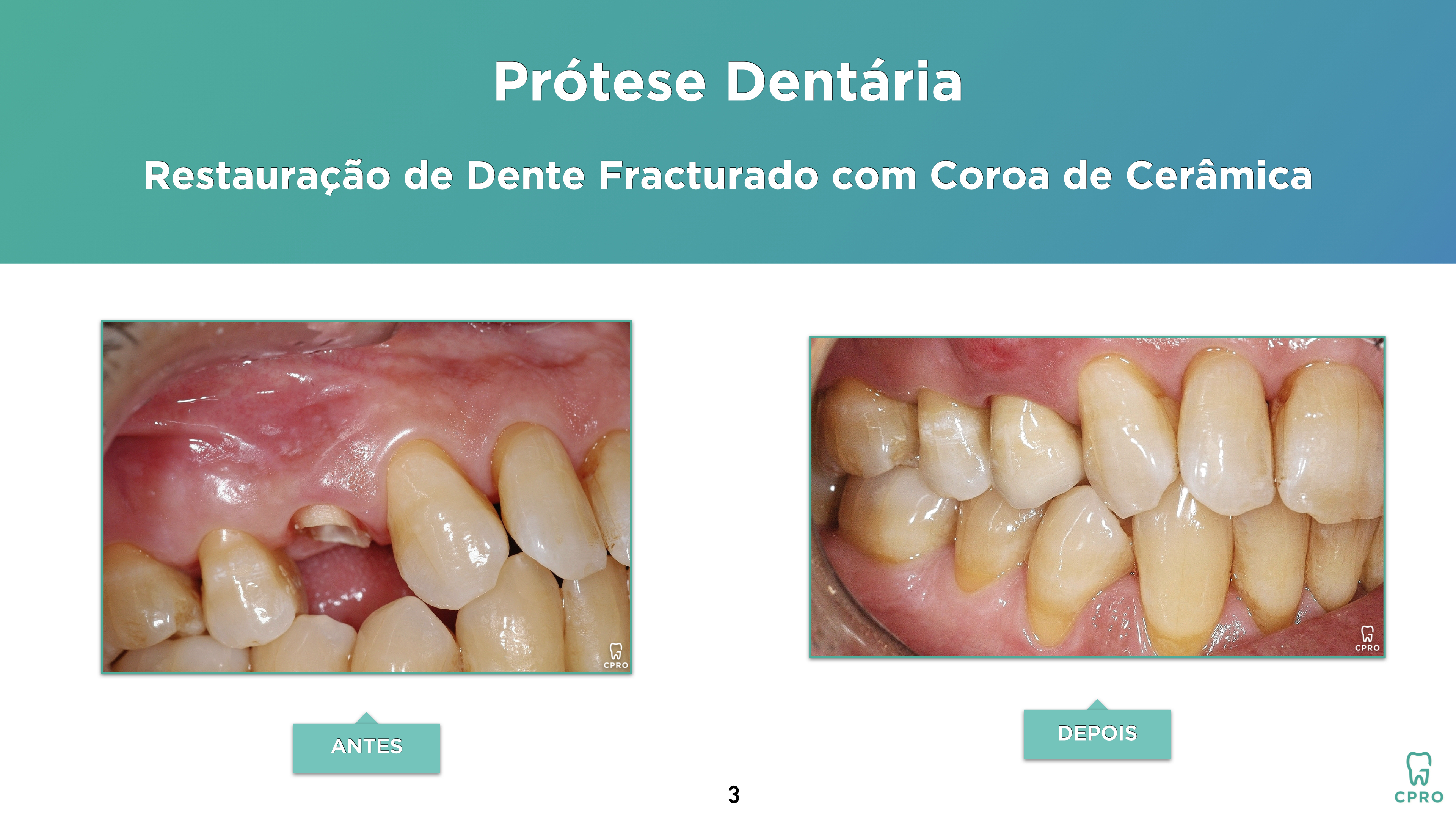 Prótese Dentária | Estética