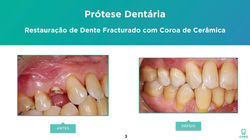 Prótese Dentária | Estética