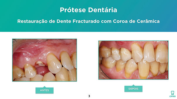 Caso Clínico de Prótese Dentária (Restau