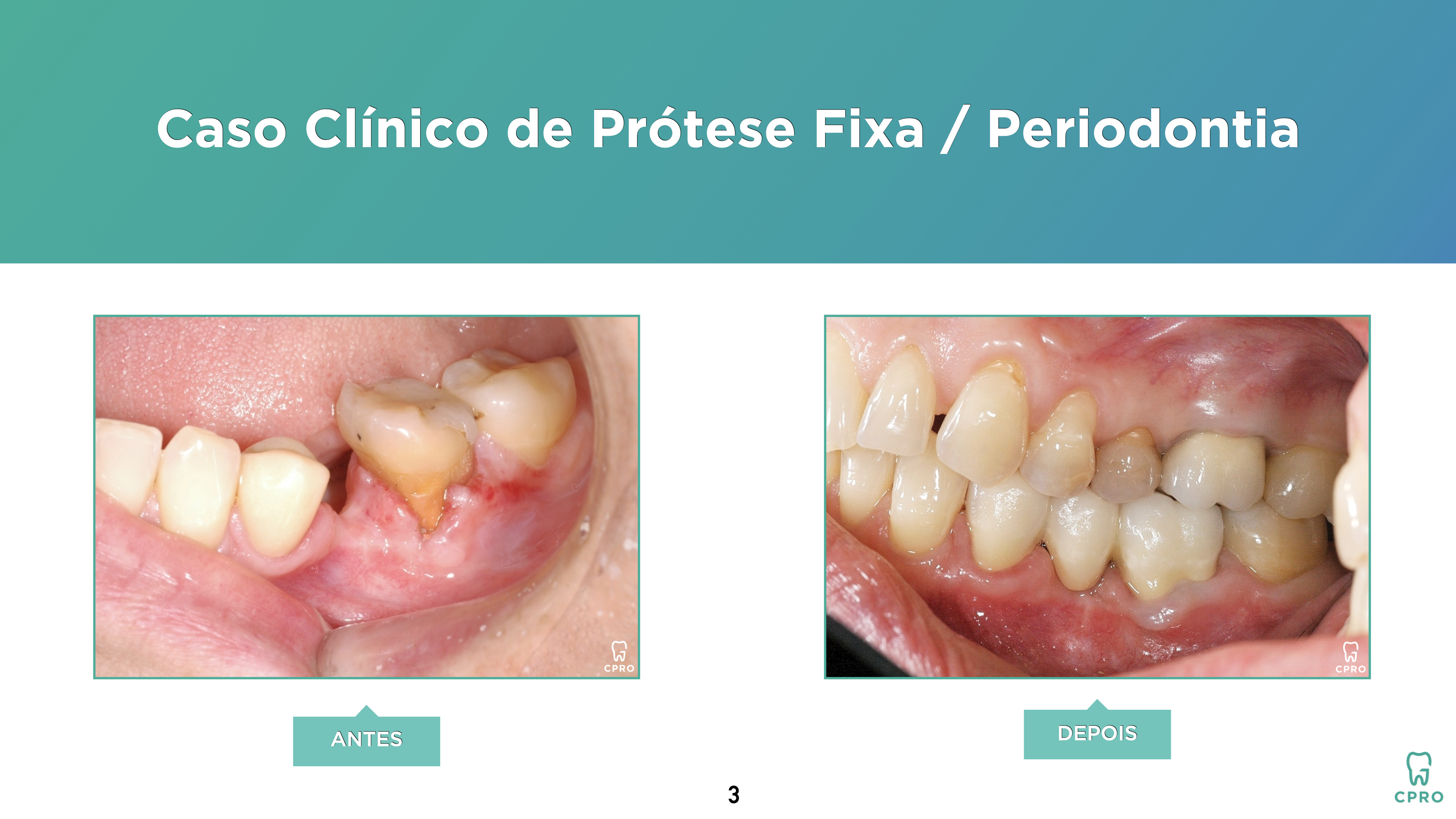 Prótese Fixa | Periodontia