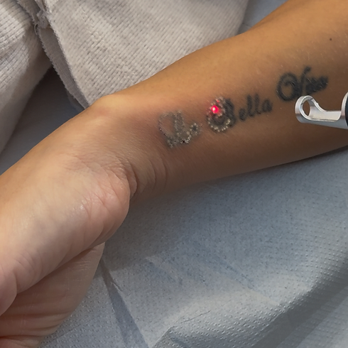 Laser tattoo removal