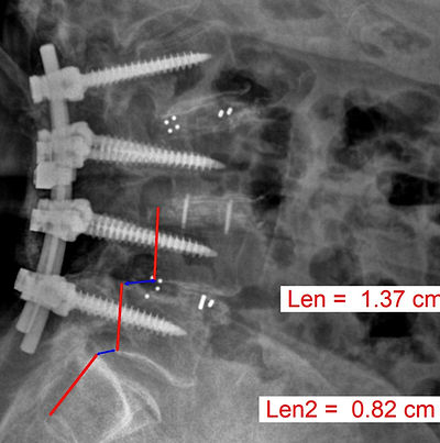 chiropractor-south jordan- spinal decompression