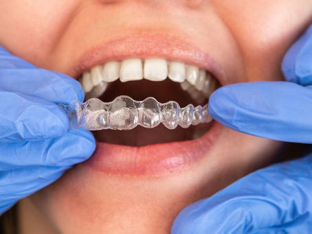 Cât de eficient este un aparat dentar invizibil?