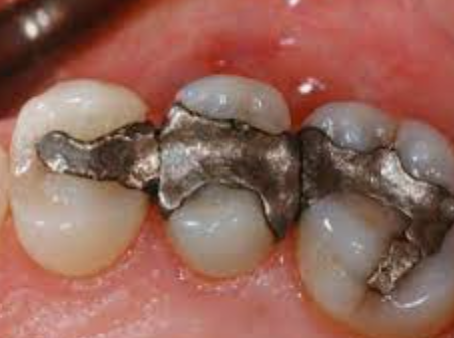 Could The Cause of Child Autism Be Related to Maternal "Silver" Fillings?