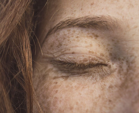 freckle.jpeg