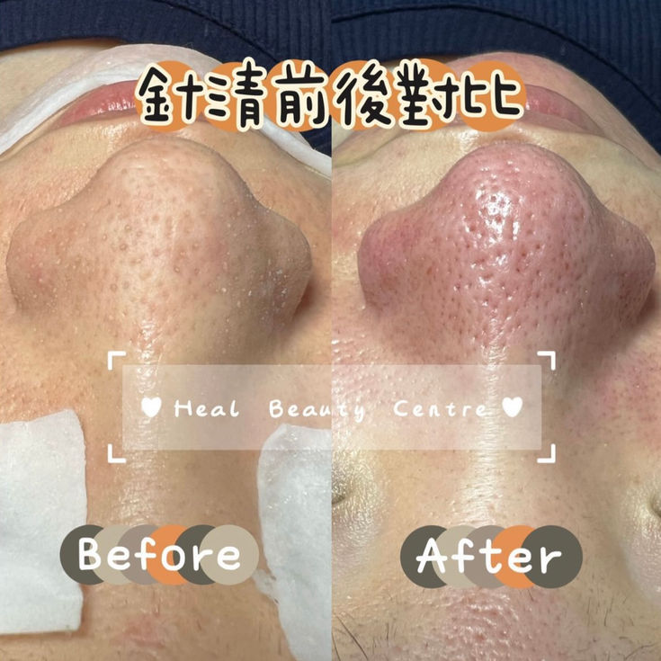 日式輕柔毛穴針清