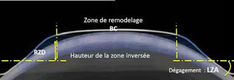 Comment ça marche? | Centre d'orthokeratologie | Aix en Provence