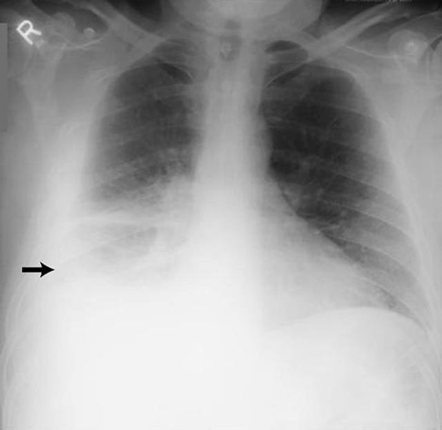 radiografía de tórax derrame pleural