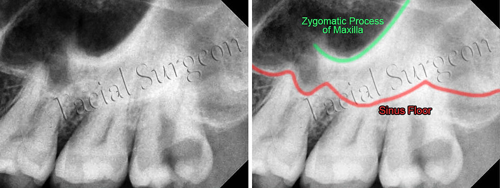 Zygomatic process of maxilla may sometimes be mistaken as Maxillary sinus floor