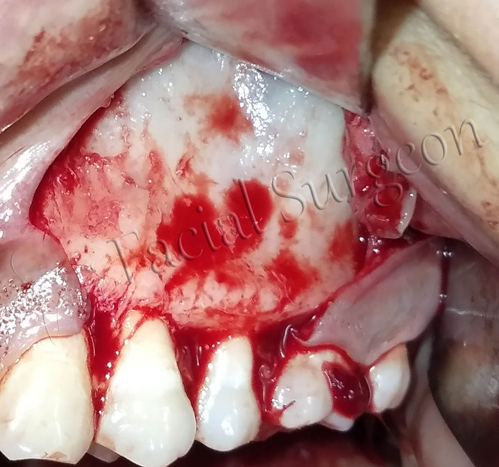Full thickness Trapezoidal Flap reflected for Caldwell Luc Surgery