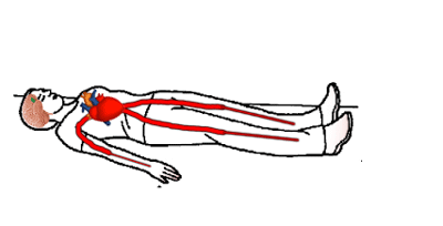 Because of peripheral vasodilation, there is pooling of excess blood in extremities like hands and legs. This causes flush (red) appearance of extremities during a syncope. (Anatomy shown here is not accurate. This is just a schematic diagram to show the blood pooling in the extremities.)