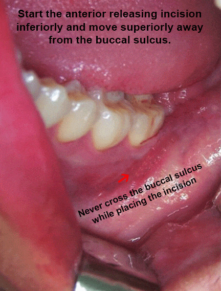 Anterior releasing incision should be started inferiorly and extend superiorly away from the buccal sulcus to prevent injury to Facial Artery