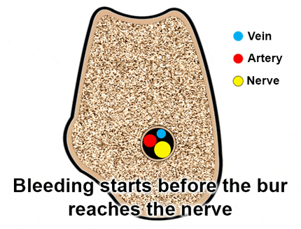 If you accidentally open up the mandibular canal while bone cutting, you will first encounter the blood vessels and then the nerve