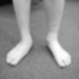 Severe Pes Planus on the right