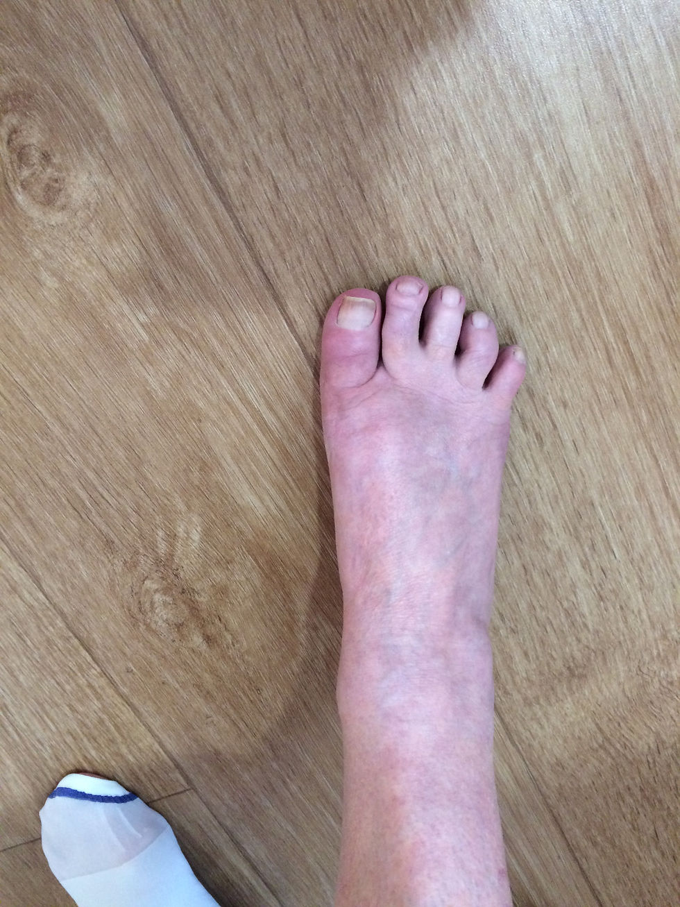 Photo of foot after
