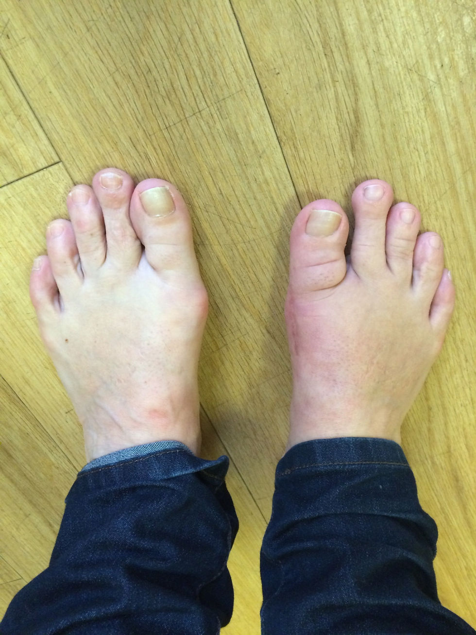 Post op patient foot