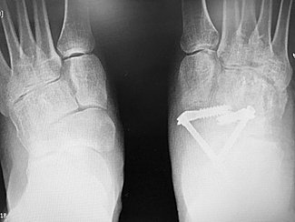 Talonavicular joint fusion surgery