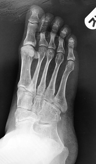 Talonavicular Joint Fusion