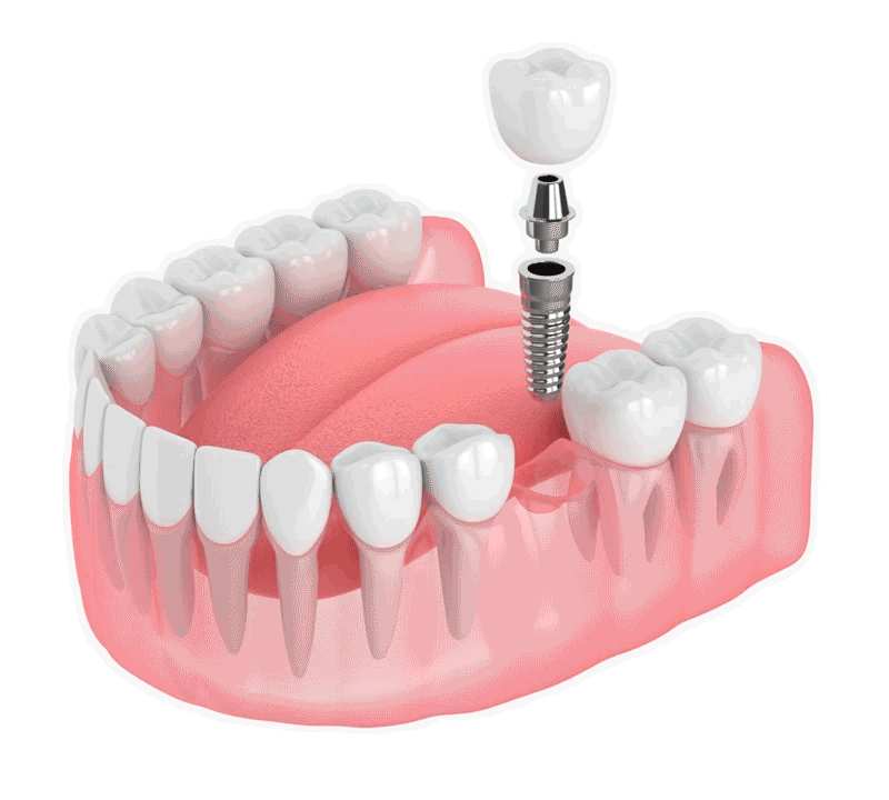 vera-dis-implant-gif.gif