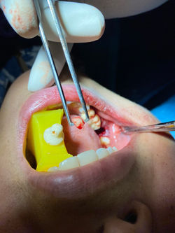 immediate implant in a fractured tooth with autograft harvest