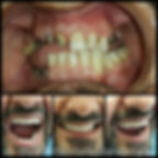 full jaw rehabilitation