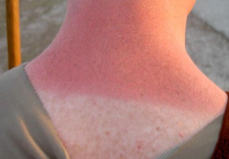 Como atuar em caso de queimadura solar