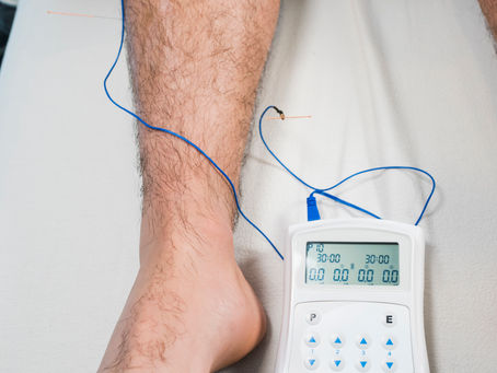 Exploring the Comprehensive Benefits of Electro Acupuncture Beyond Pain Relief