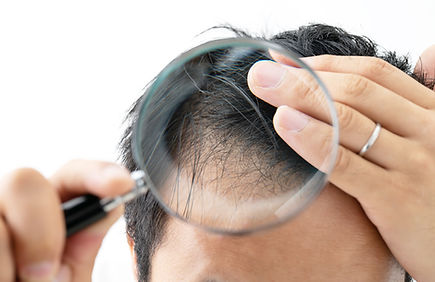 AGA（男性型脱毛症）