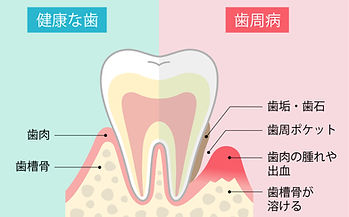 歯周病治療の説明図