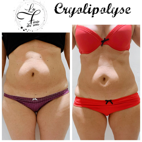 RESULATS AVANT_ APRES 3 SEANCES cryolipo