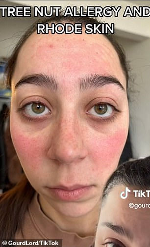 @GourdLord on TikTok shares a photo of her allergic reaction on the app