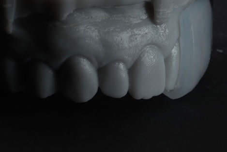 After forming of the mouthguard, we cut it in half to evaluate the fit. It is ideal.