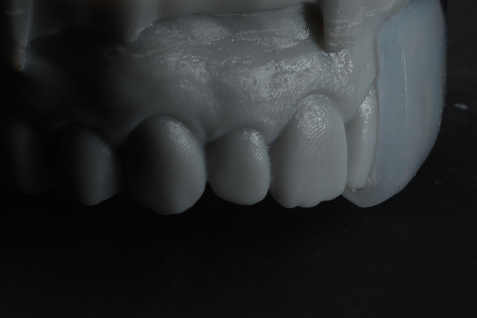 After forming of the mouthguard, we cut it in half to evaluate the fit. It is ideal.