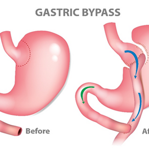 Protein and Gastric Bypass Surgery