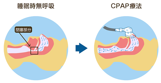 睡眠時無呼吸症候群 アリオ北砂内科 公式 江東区北砂の内科