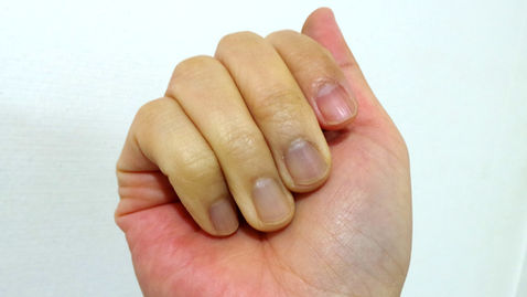 Hand-Arm Vibration Syndrome - Analysing the Subsequent Effects From Exposure