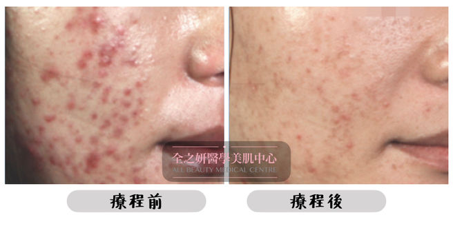 All Beauty全之妍 M22 暗瘡療程效果2.jpeg
