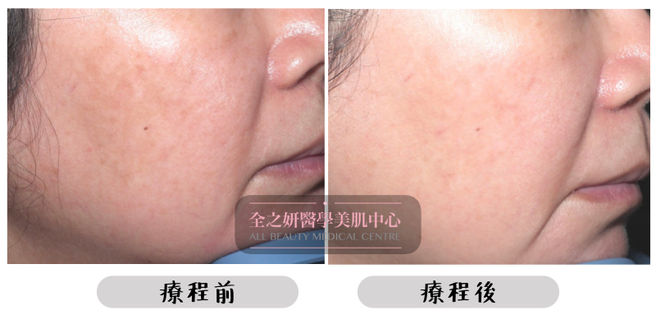 All Beauty全之妍 M22 色斑療程效果8.jpeg