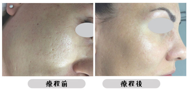 All Beauty全之妍 M22 暗瘡療程效果5.jpeg