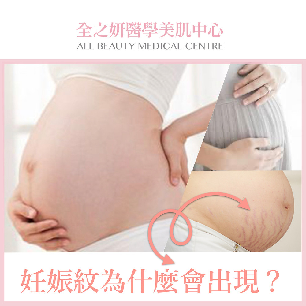 妊娠紋 懷孕 出紋 新手媽咪