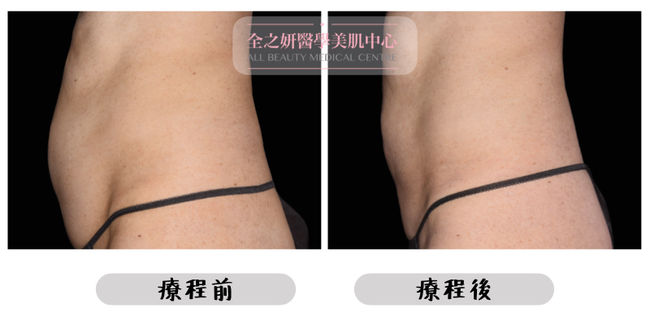 BTL EMSCULPT NEO 增肌減脂前後 BEFORE AFTER All Beauty全之妍 1.jpeg.jpeg